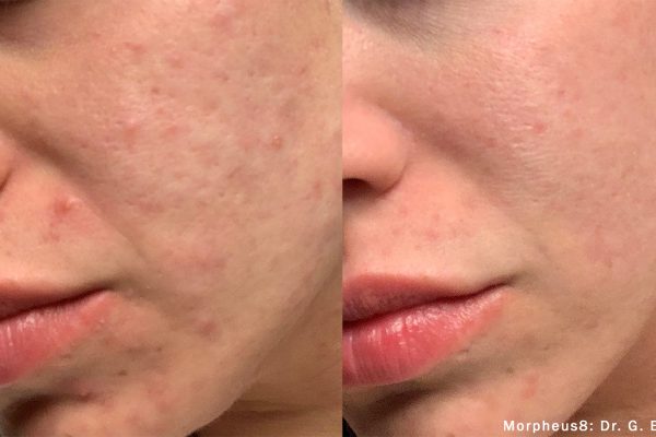 GE_Morpheus8_1_Acne20kj