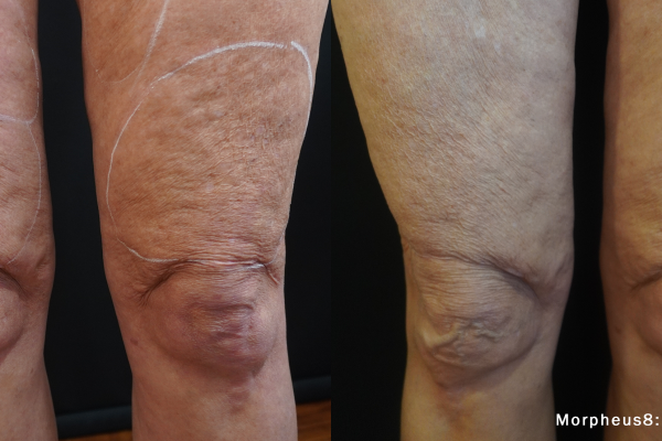 VR_Morpheus8_1d_1txThighs63yrs